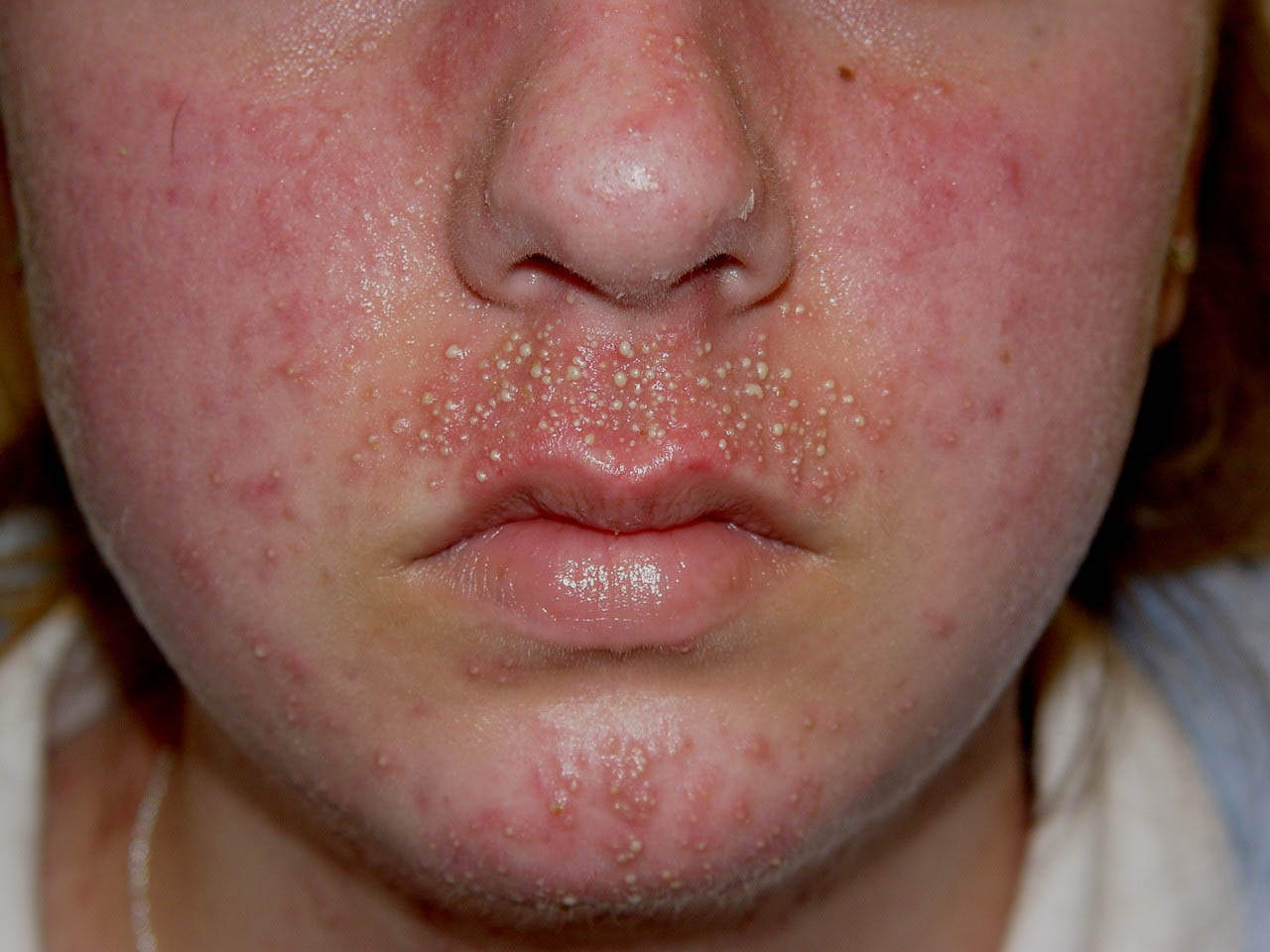 Steroid_rosacea = \u0627\u0644\u0639\u062f \u0627\u0644\u0648\u0631\u062f\u064a \u0627\u0644\u0643\u0648\u0631\u062a\u064a\u0632\u0648\u0646\u064a