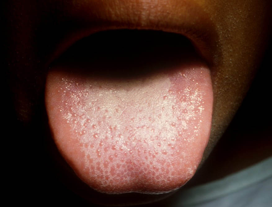 Strawberry Tongue — NEJM