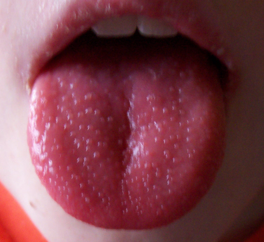 strawberry tongue pictures