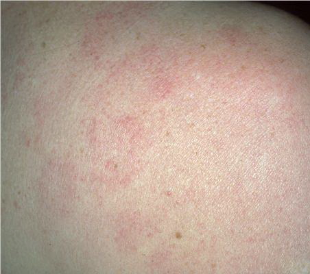 Cutaneous lupus erythematosus: An update