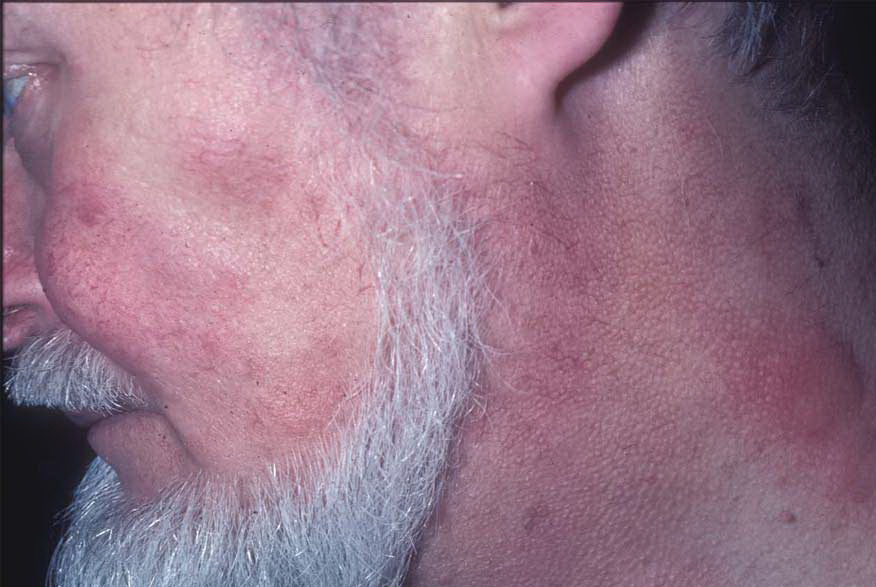 Cutaneous Lupus Erythematosus: An Update - Medscape