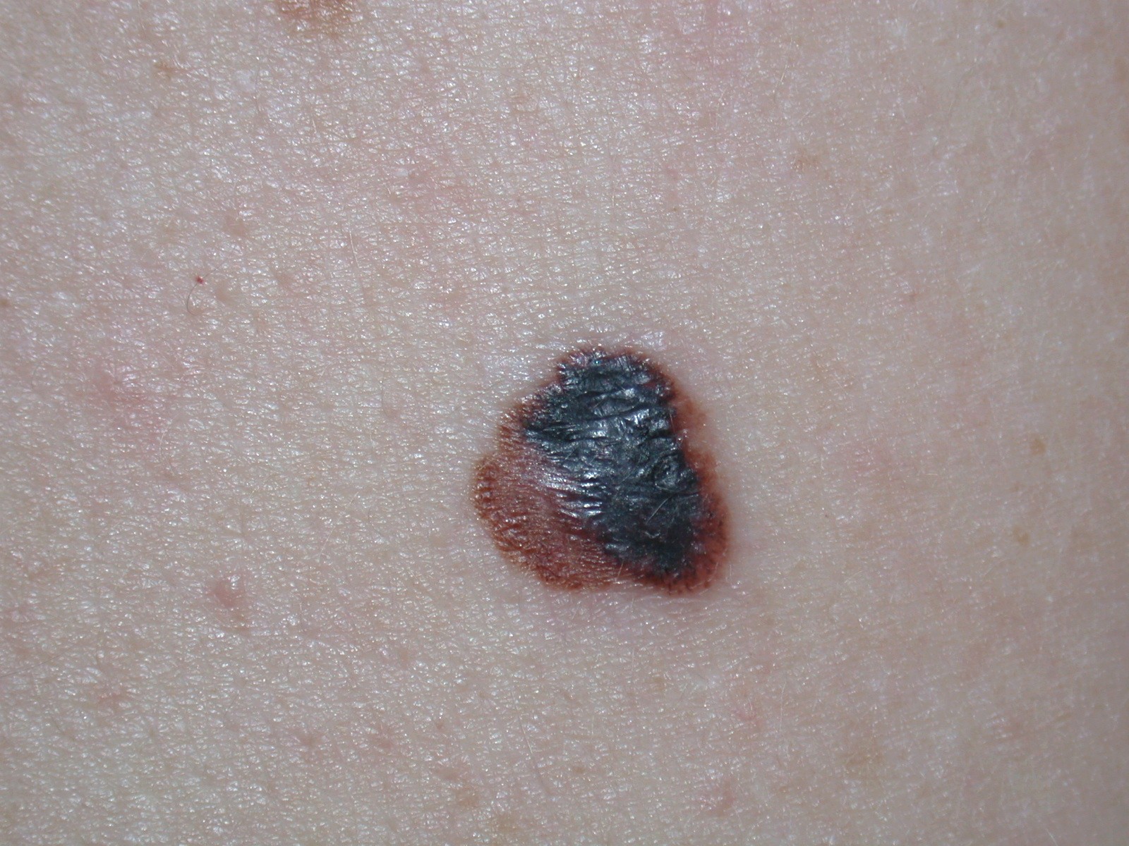 Superficial spreading melanoma - Dermatology Society
