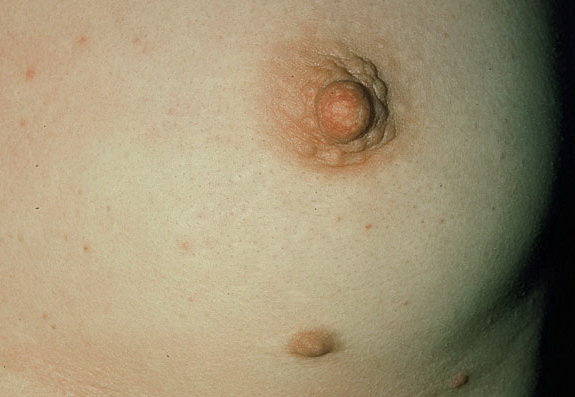 Supernumerary nipple | Genetic and Rare Diseases ...