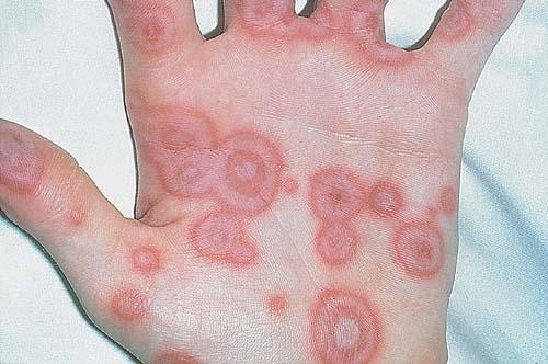 Dermatologic Manifestations of Urticarial Vasculitis