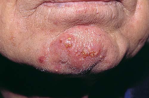 What is Tinea Capitis or Tinea Barbae? | Ringworm ...