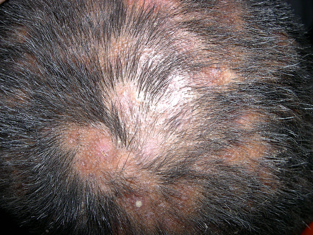 Tinea Capitis: Background, Pathophysiology, Epidemiology