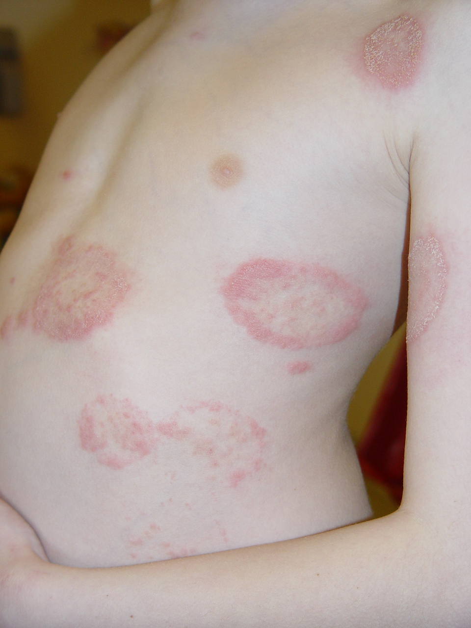 tinea corporis picture #11