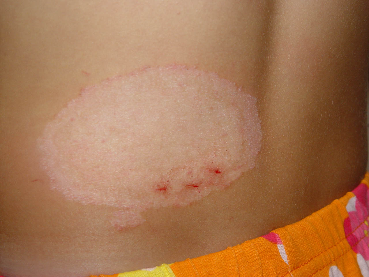 Tinea Corporis Pictures | MedicalPictures.net