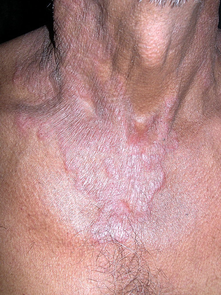 tinea corporis images