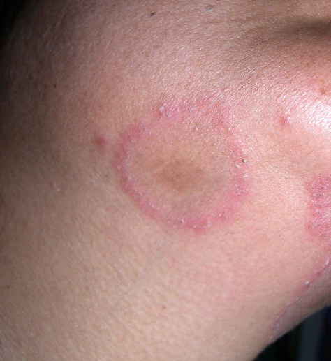 Ringworm Tinea Pedis Picture Image on MedicineNet.com