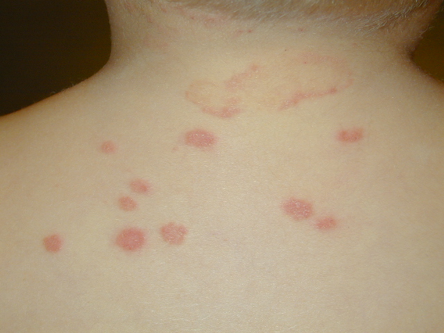 ringworm in children