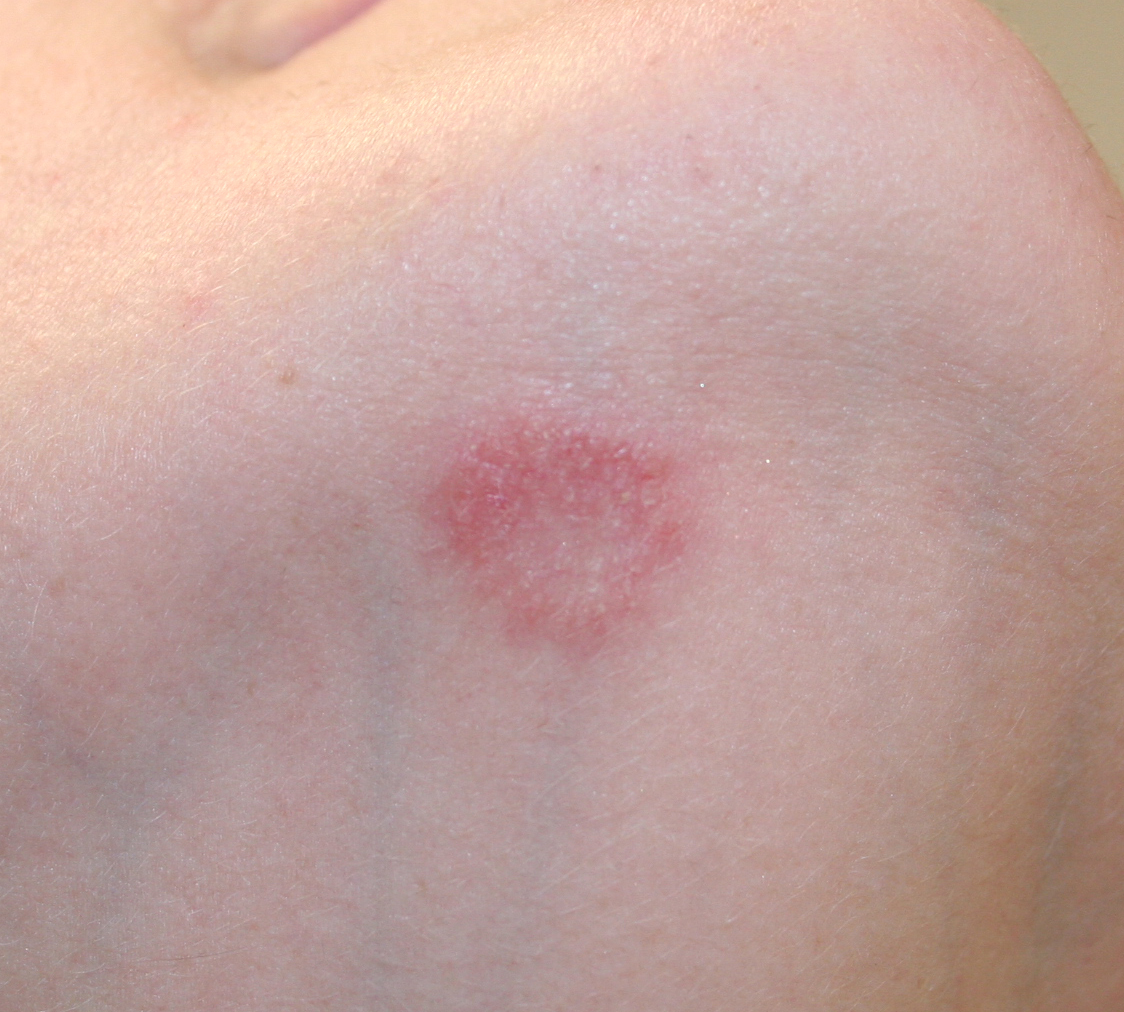 tinea corporis picture