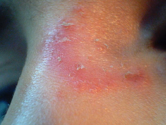 Tinea - Wikipedia