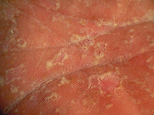 Fungus of the Feet and Nails - Medscape