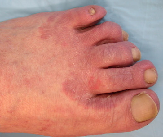 Ringworm Tinea Pedis Picture Image on MedicineNet.com