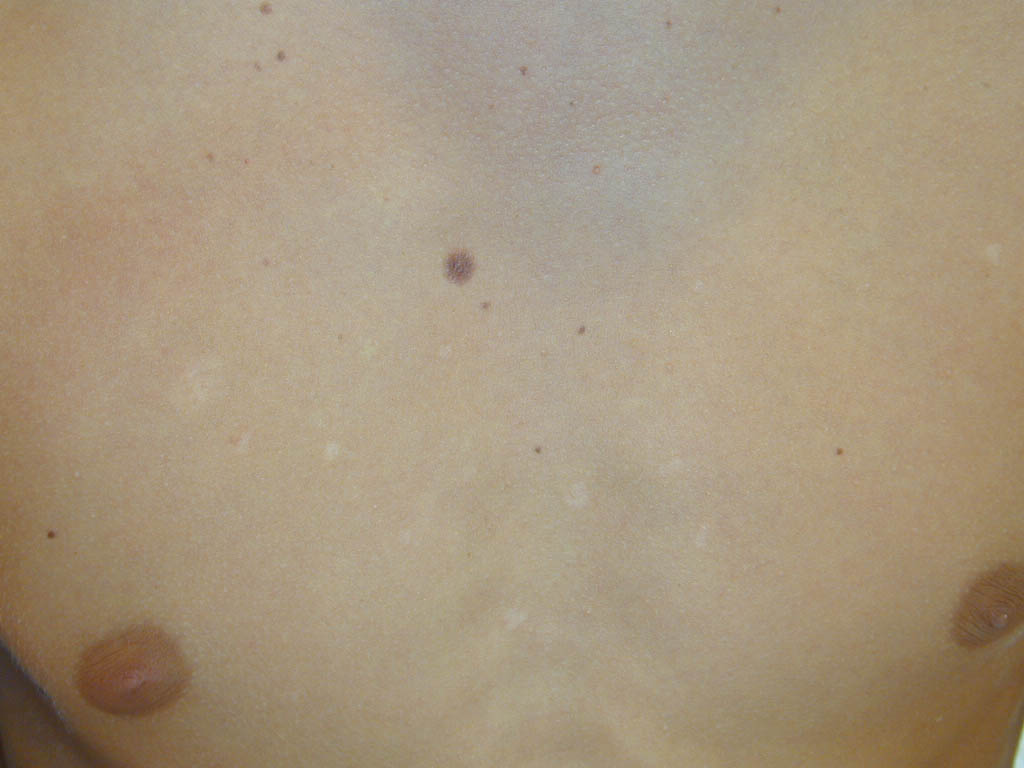 What is Tinea Versicolor? - Tinea Versicolor Definition ...