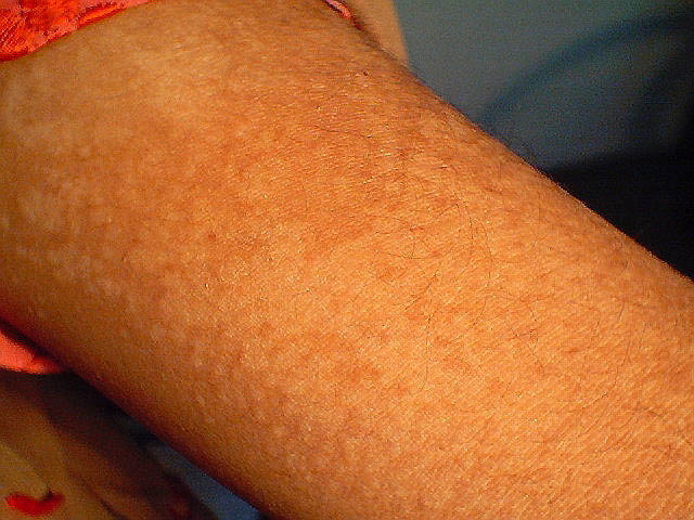 what is tinea versicolor