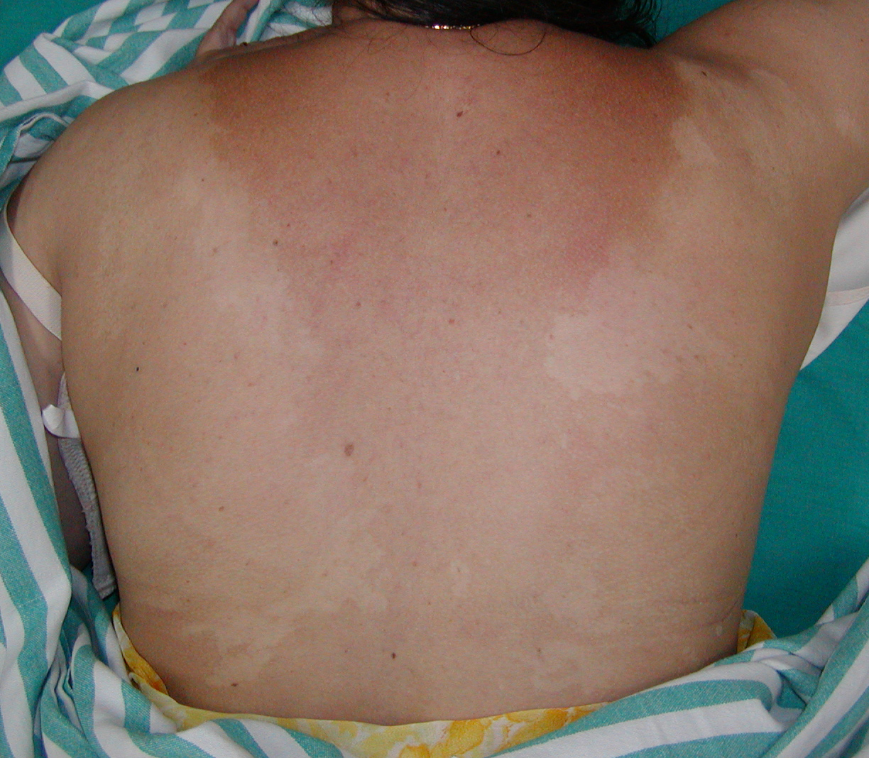 Tinea versicolor: MedlinePlus Medical Encyclopedia