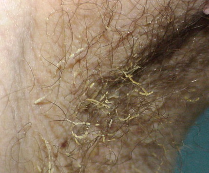 Trichomycosis Axillaris? HELP!!! Pubic hair Issue ...