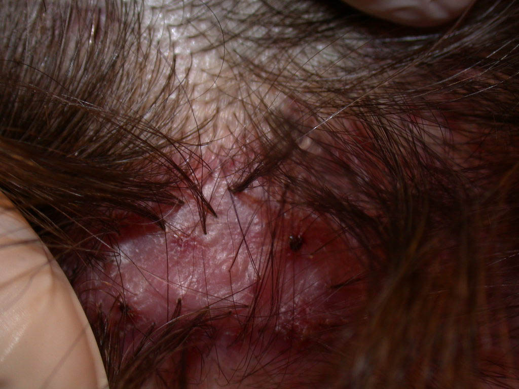 Staph Infections: Folliculitis, Furuncles, and Carbuncles ...