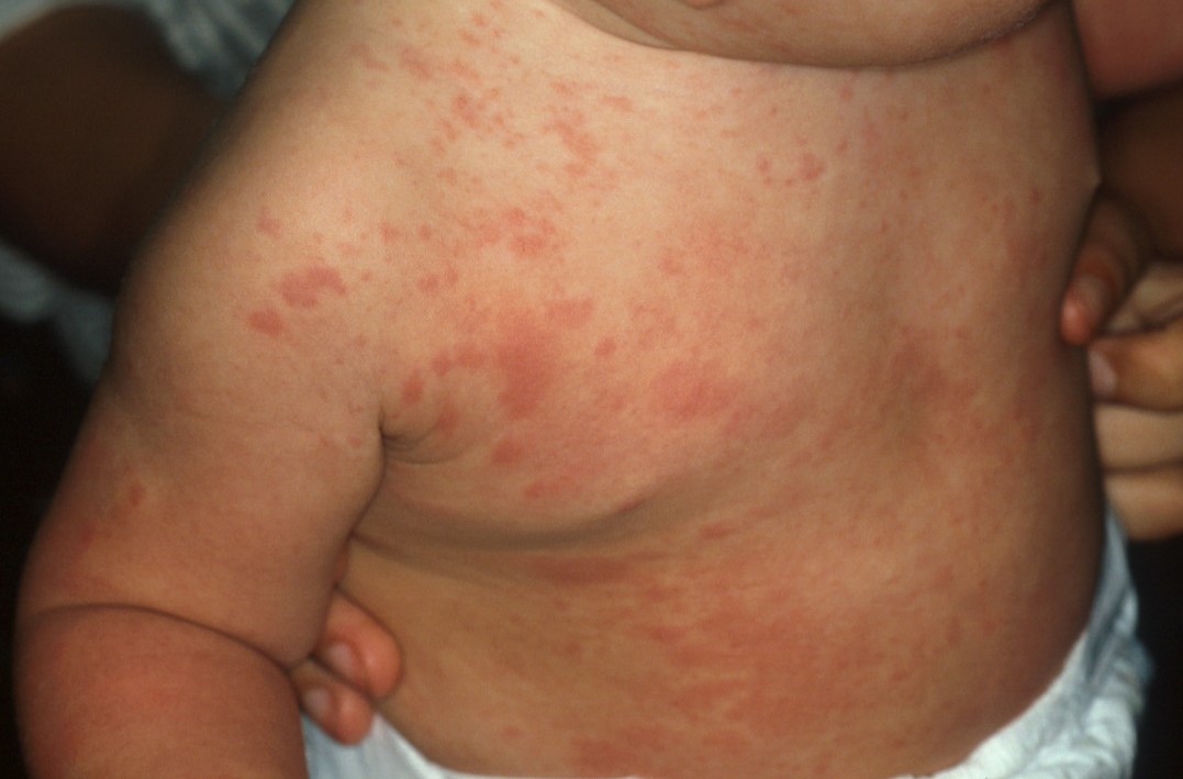 photos of hives rash
