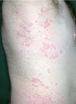 Hypocomplementemic Urticarial Vasculitis Syndrome