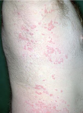 Cutaneous small-vessel vasculitis - Wikipedia