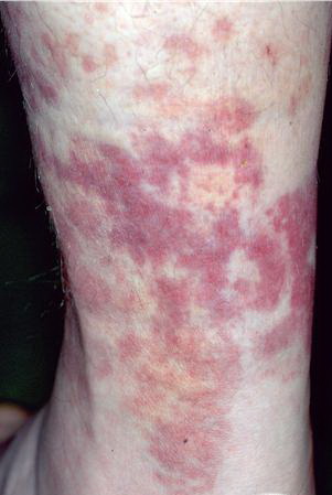 Urticarial Vasculitis - Vasculitis UK