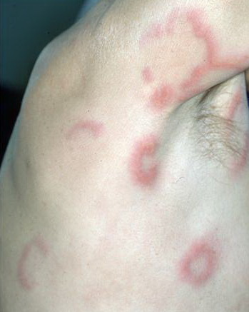 urticarial vasculitis symptoms #11