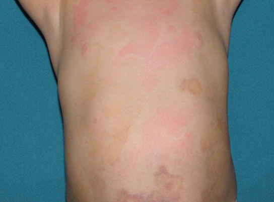 urticarial vasculitis #10