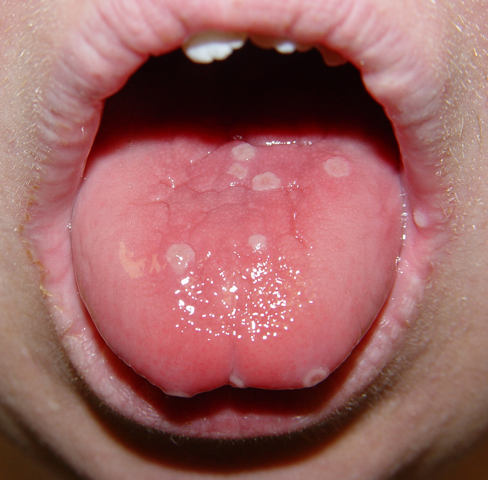 hairy tongue images