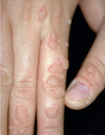 common warts on legs. common warts on fingers.