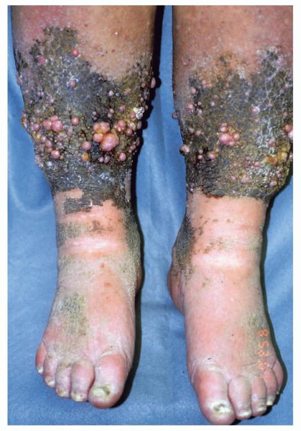 venous stasis dermatitis pictures #10