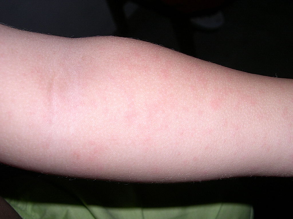 viral exanthem pictures