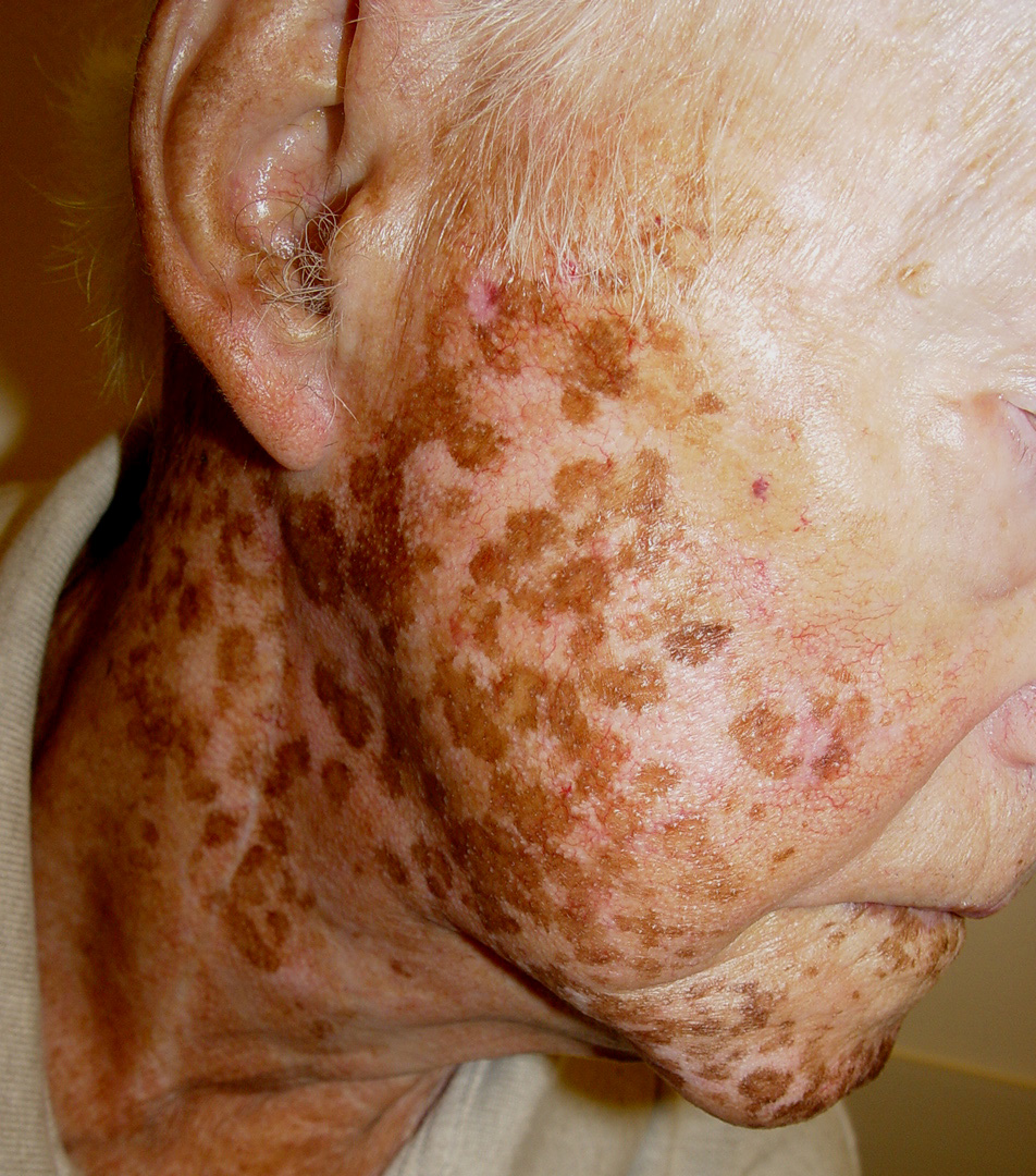 Vitiligo Treatment Excimer Laser : Benoquin Cream For Skin De Pigmentation And Vitiligo Treatment