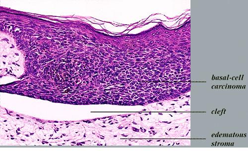 Basal Cell Carcinoma Superficial الورم القاعدي الخلايا السطحي
