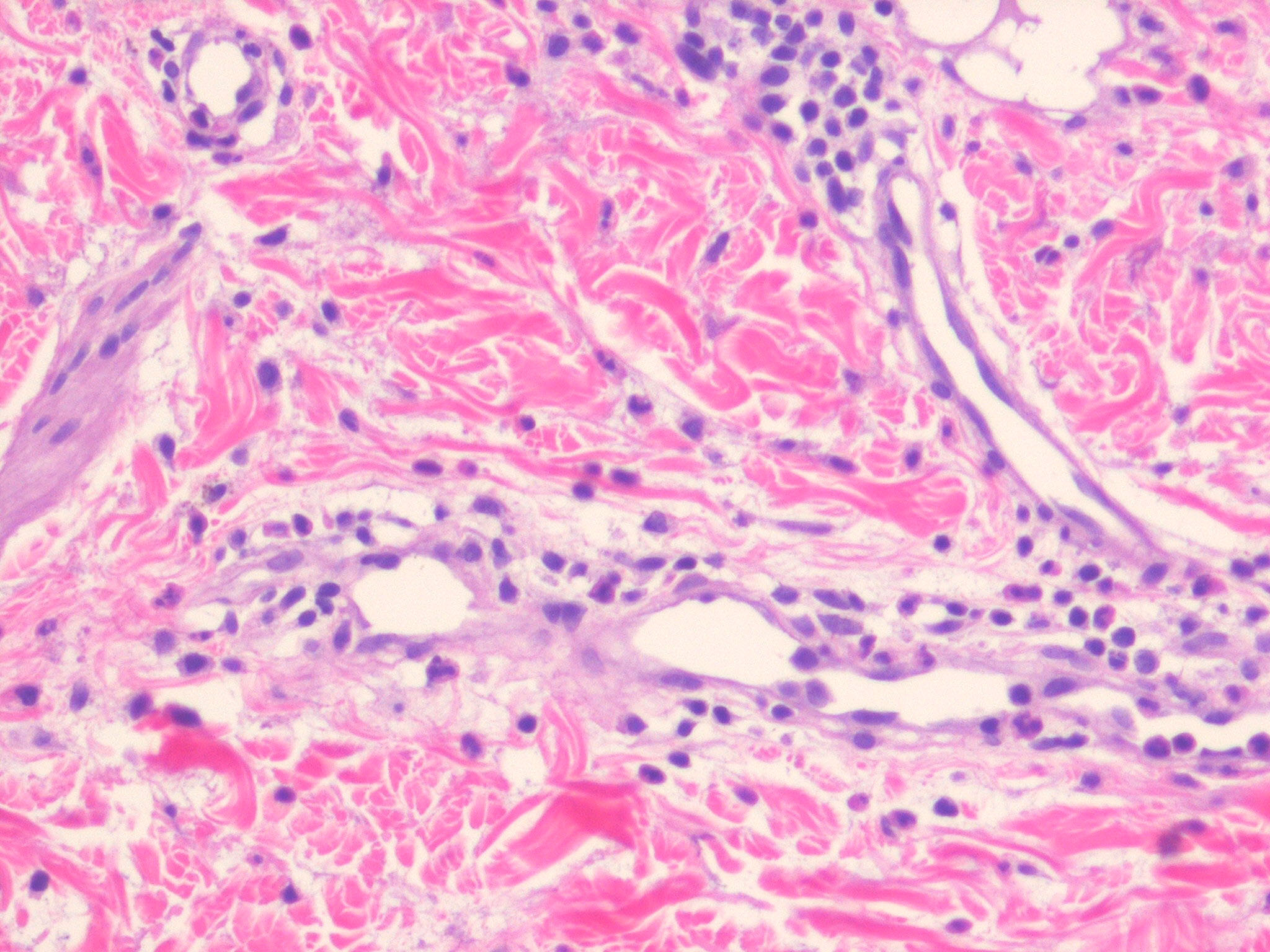 discoid lupus scalp pictures, photos