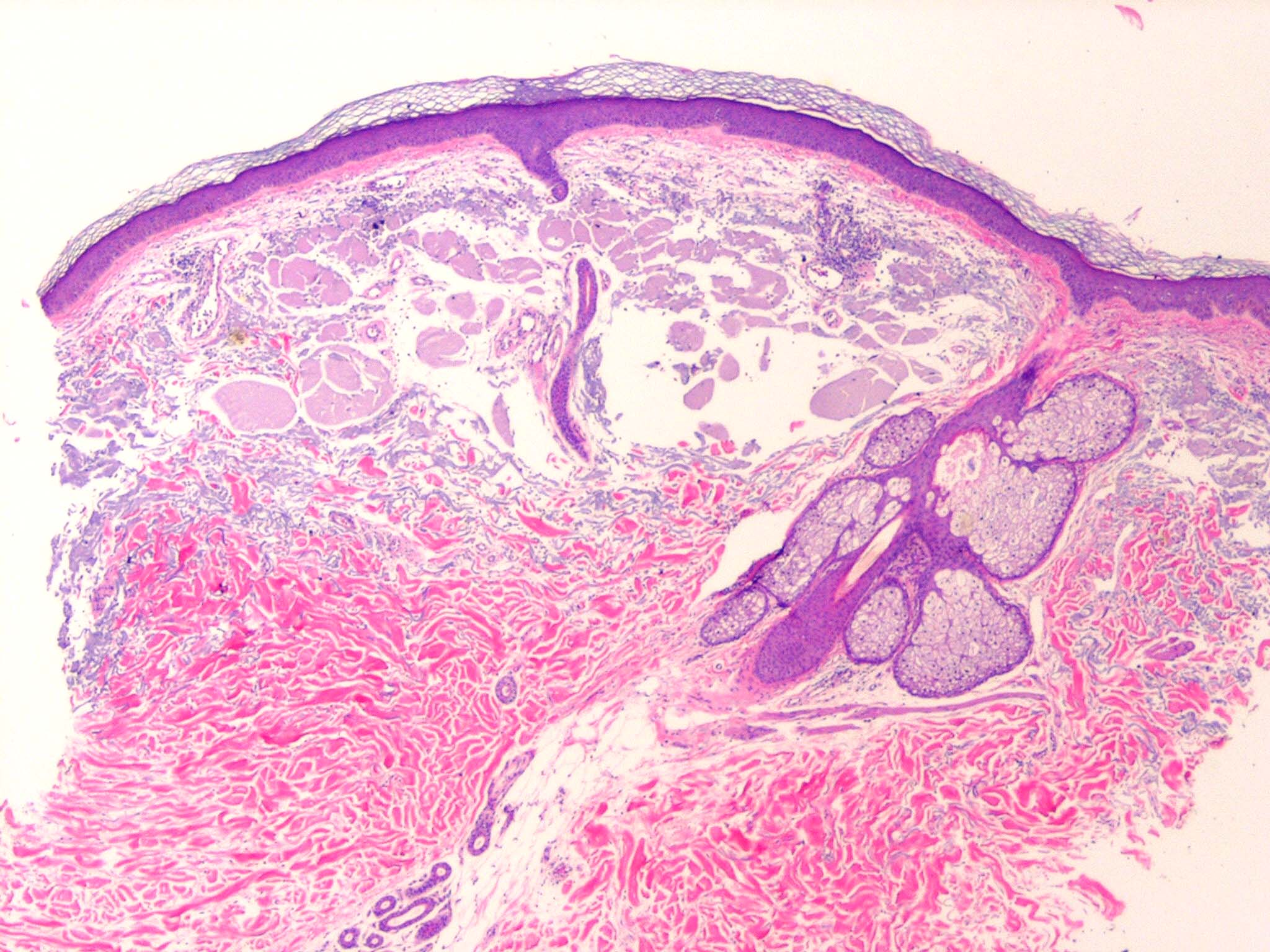 colloid milium