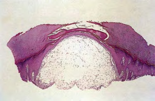 Digital Mucous or Myxoid Cyst - DermNet NZ