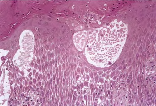 Dyshidrosis Overview - Mayo Clinic