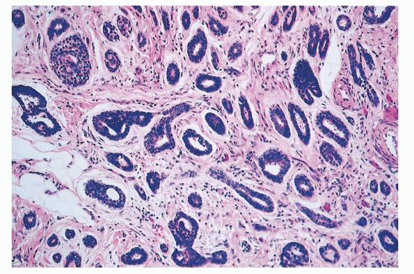 eccrine carcinoma