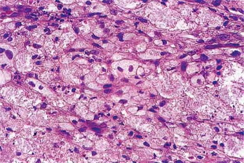 Eruptive Xanthoma — NEJM