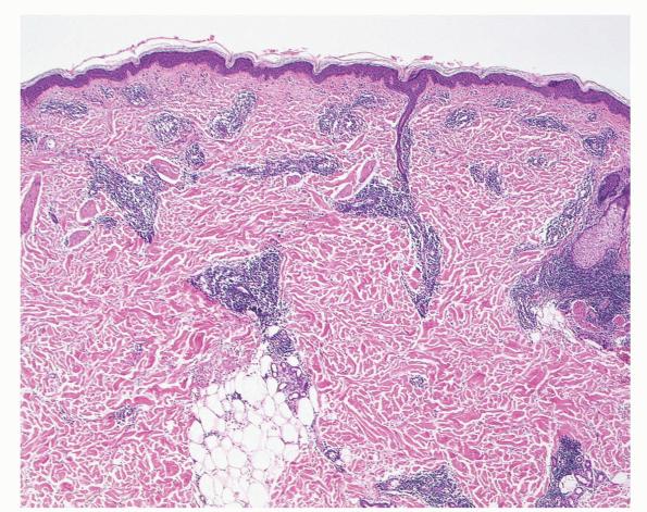 Erythema Annulare Centrifugum =الحمامى الحلقية النابذة