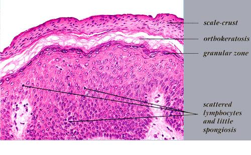 guttate dermatosis mycosis fungoides1