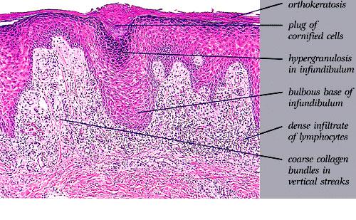 Lichen simplex chronicus: symptomen, oorzaak en ...