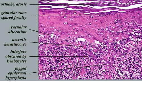 Lichen Planus op het hoofd - Lichen Planus Vereniging ...