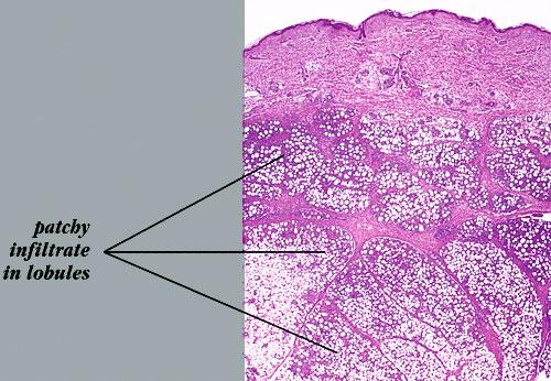 Panniculitis Symptoms, Diagnosis, Treatments and Causes ...