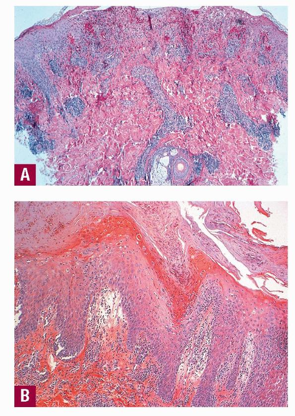 Mucha Habermann disease - WebMD