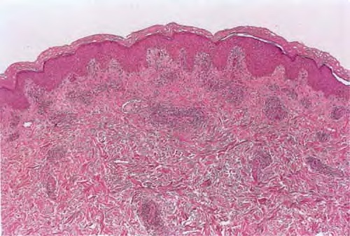 Mucha-Habermann syndrome: Introduction - Right Diagnosis