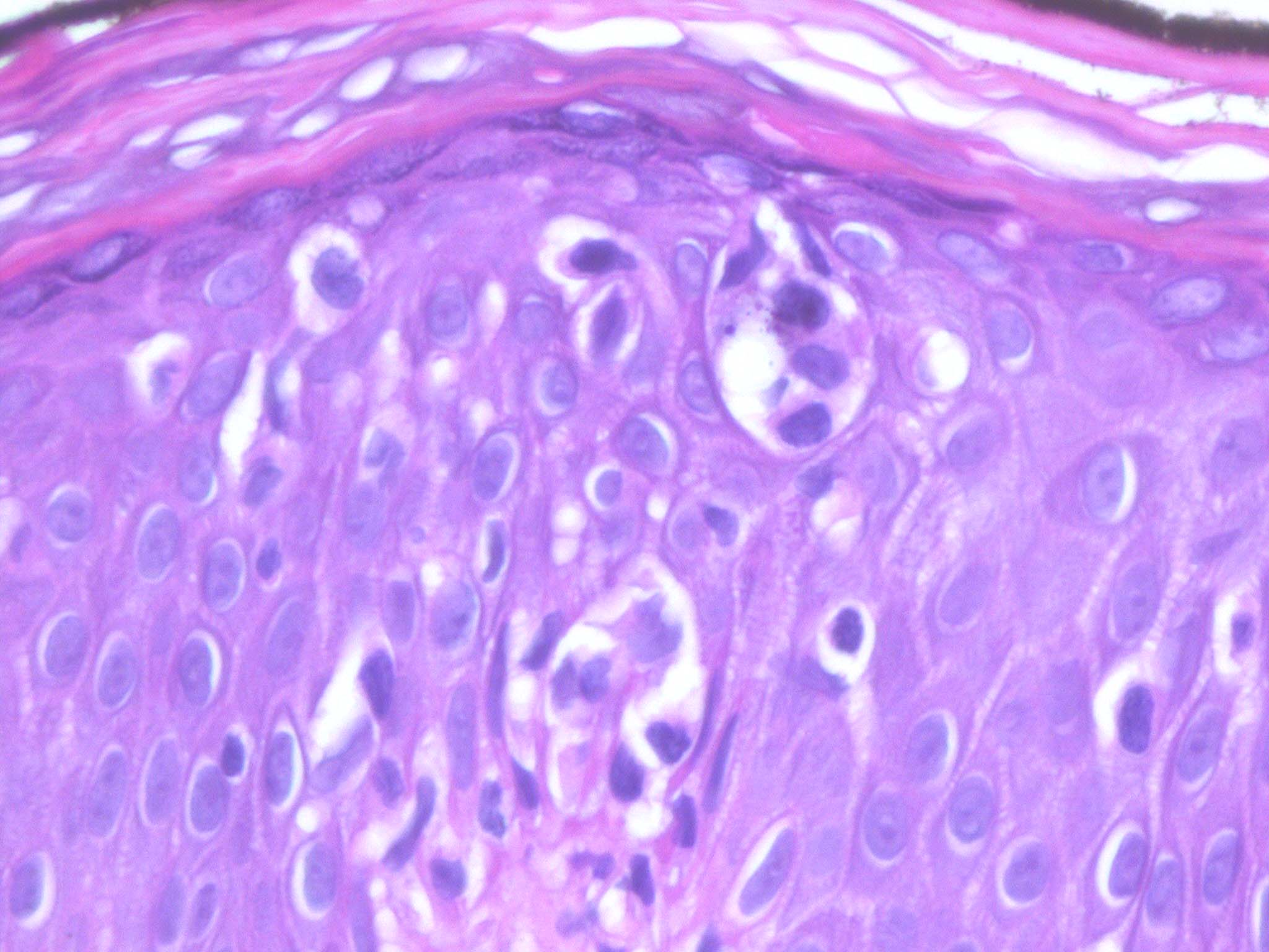 Sézary Cells - 2.